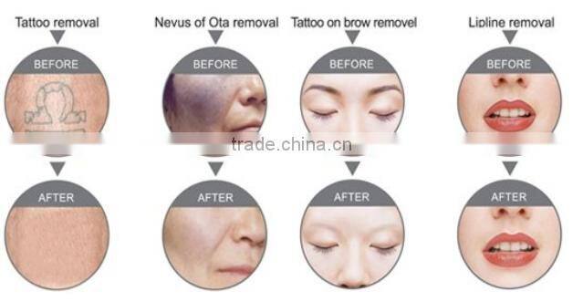 Manufacturer supply!!!! cheapest q switch nd yag laser tattoo removal system