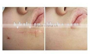 RF co2 franctional laser with auto intelligent controller for acne Scar remover