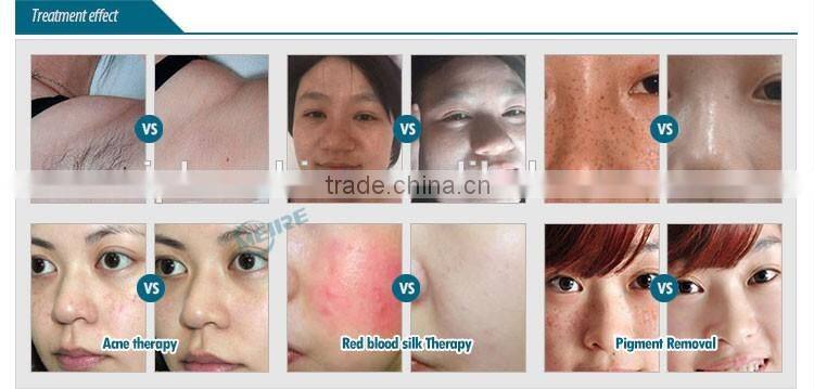 Hot selling vertical opt shr ipl hair remover shr