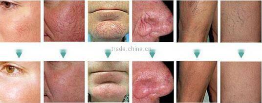 Rbs 30Mhz high frequency spider veins removal vascular therapy machine