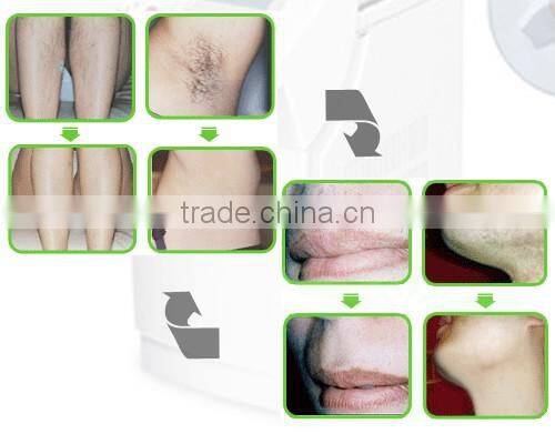 OEM IPL shr hair removal machine Q switched nd yag laser tattoo removal machine