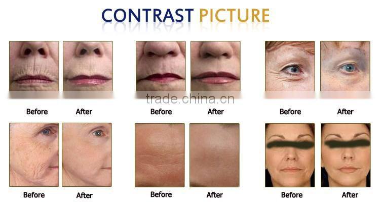 2016 ultrasonic smas system hifu body body and face treatment