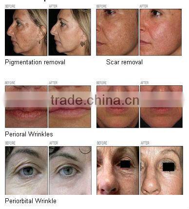 high quality Factory price laser carbon powder beauty