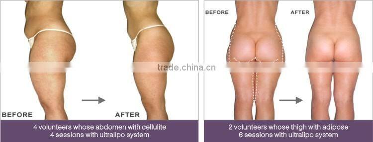 SUS Cavitation RF Ultrasonic machine perfect body sculpt cavitation rf slimming machine