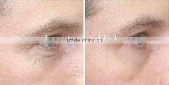 2016 hot 1200 needles body roller 3in1 derma cosmetic roller kit for dermatology