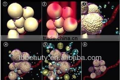 Inner Roller low cost liposuction