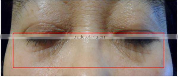 Hot!!! New products,portable home hifu anti-wrinkle machine /hifu machine home