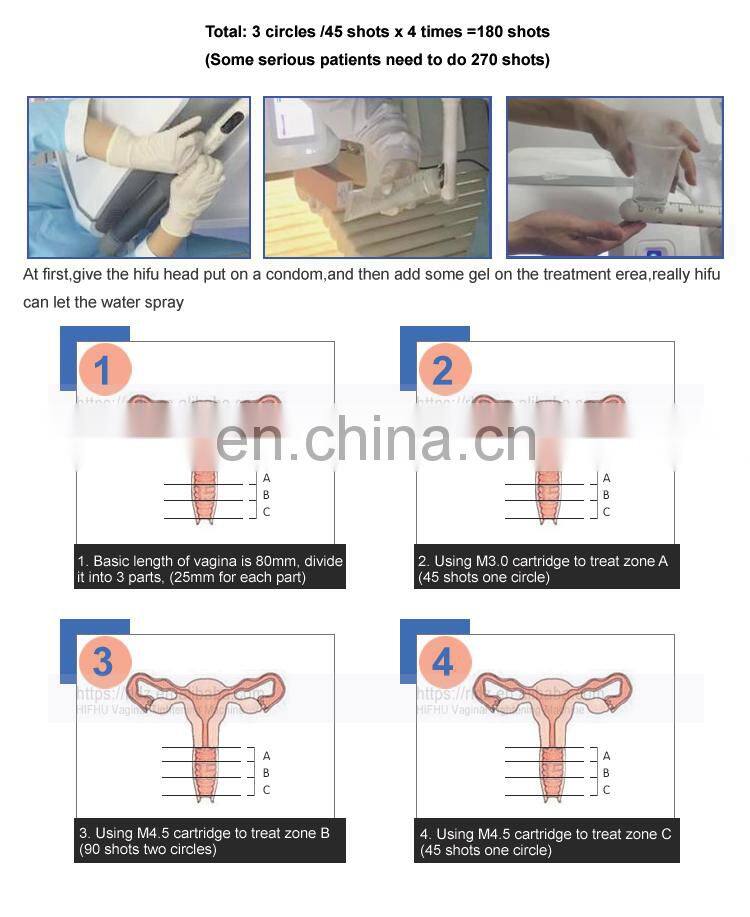 360-degree vaginal tightening Hifu skin rejuvenation treatment machine