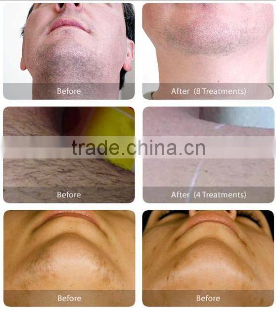 2016 High quality diode laser 808nm & 810nm hair removal machine with CE