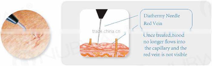 Clinical medical laser varicose veins laser treatment NBW-V600