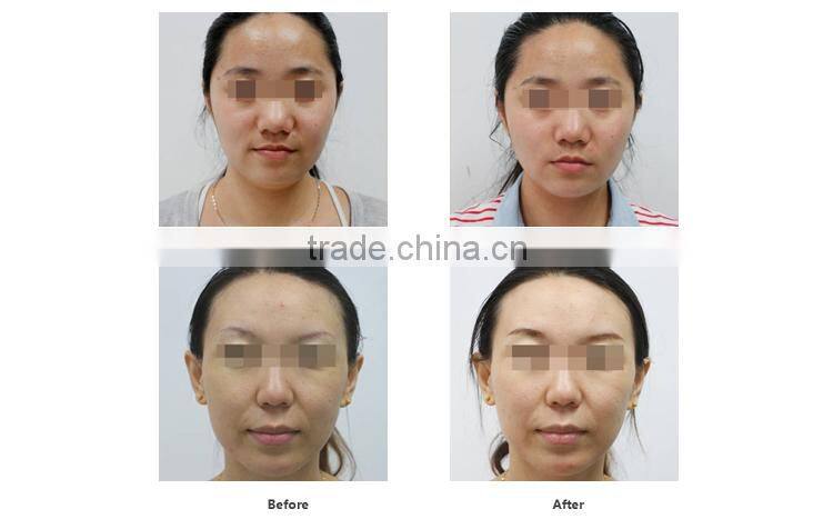 DEESS GP550 organic skin care slim face remove wrinkles mini home use machine