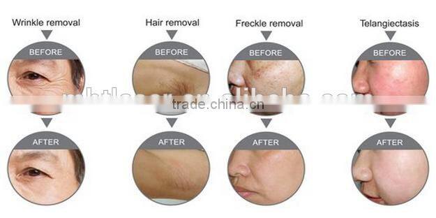 MBT new style SHR / OPT / IPL + elight + RF Multifunctional IPL SHR