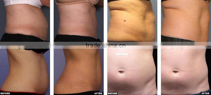 Factory price hot sale beauty machine high-intensity focused ultrasonic HIFU body shaping machine