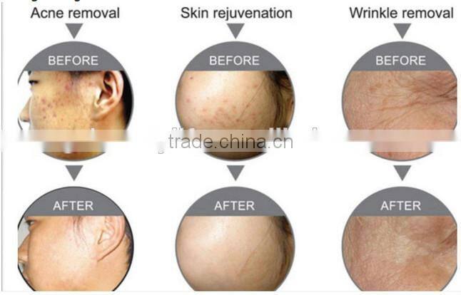 Hotselling bio light therapy pdt led light skin whitening pdt machine