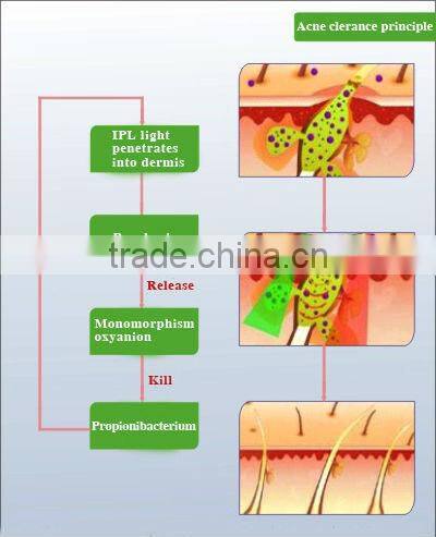 2015 top seller laser beauty equipment laser for hair loss