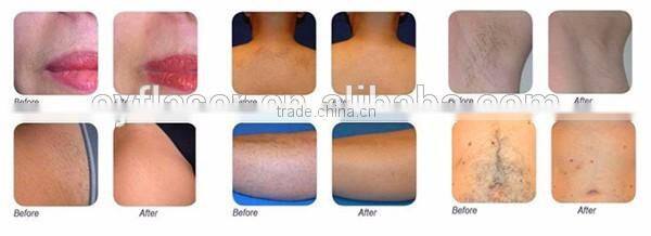 Newest 808nm permanent diode laser hair removal