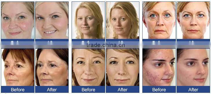 The latest model 2016 pore cleaning injection oxygen jet machine with skin detection