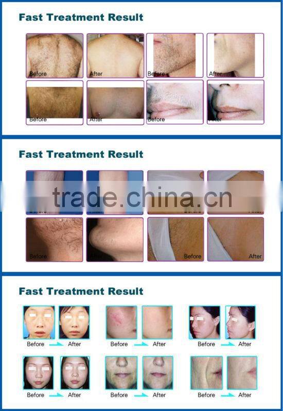 CE SGS ISO TUV Approved Hot sellingipl shr laser hair removal machine