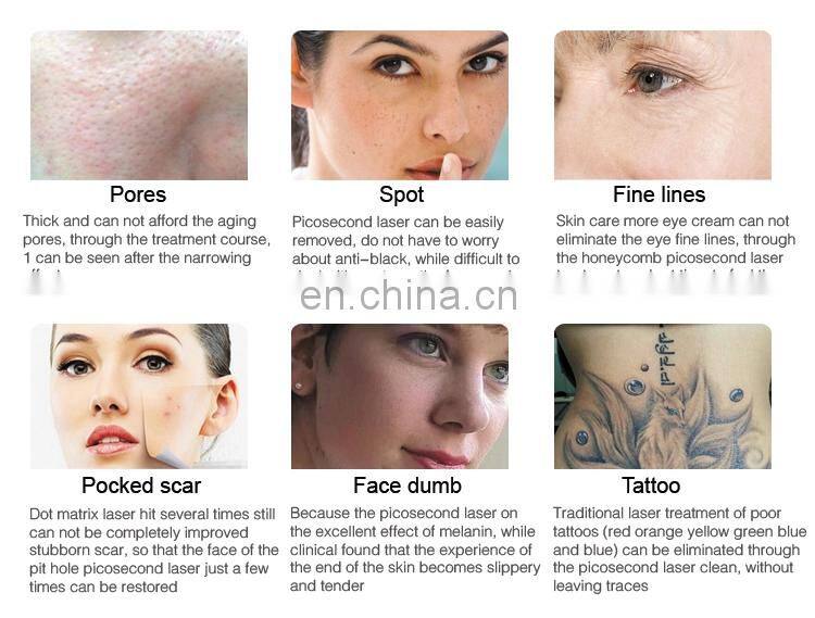 Niansheng factory pico laser machine pico laser tattoo removal machine pico