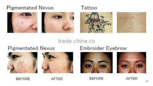 K10 Tattoo Removal Feature Nd: Yag Laser Laser Type tattoo removal machine price