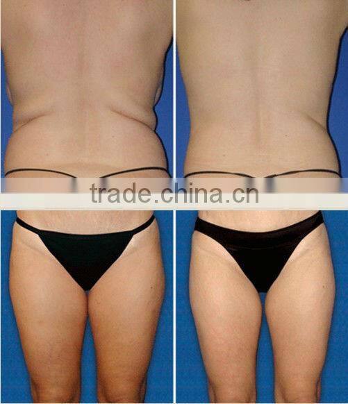 High quality cryo fat freezing equipment/ cryolipo slimming instrument/stand cryotherapy