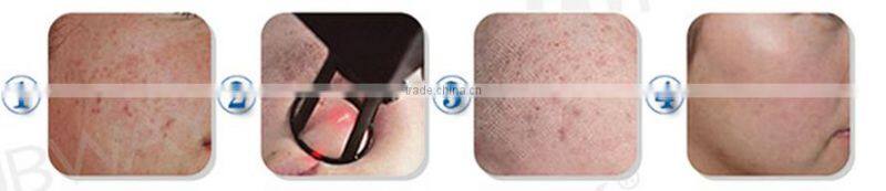 2016 best-selling fractional laser co2 skin resurfacing / scar removal treatment high power co2 laser cutting machine