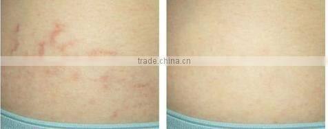 beauty studio acne scars treatment body dermaroller 1080 needles -L008