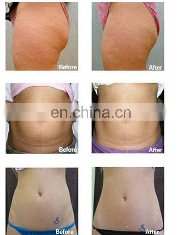 trilipo fast ultrasonic liposuction cavitation machine for sale slimming system
