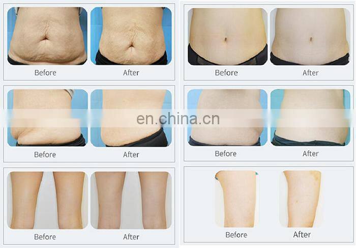 Home Use Fat Freezing Cool Body Sculpting Cryotherapy Machine for Sale