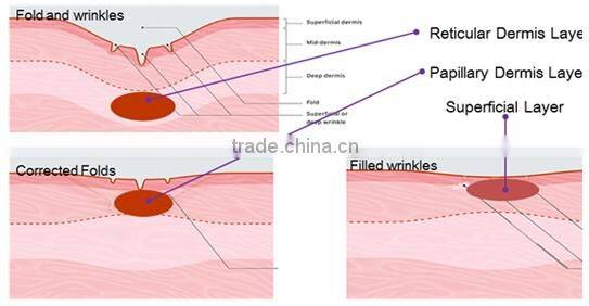 2 professional treatment handles radiofrecuencia fraccionada