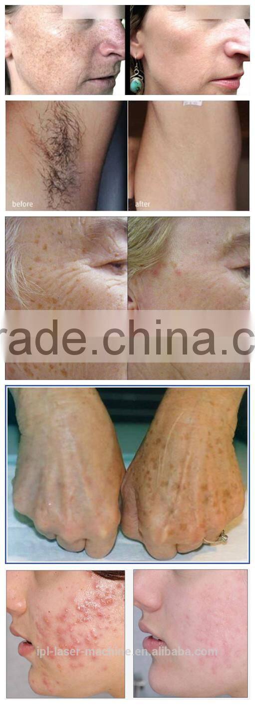 WOW!!! Low factory direct selling price!!! 3 handles ipl hair removal / ipl machine / ipl hair removal system