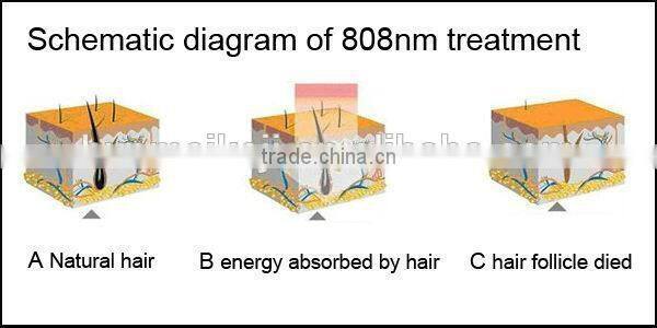 Hot selling hair removal 808nm diode laser machine / diode laser hair removal