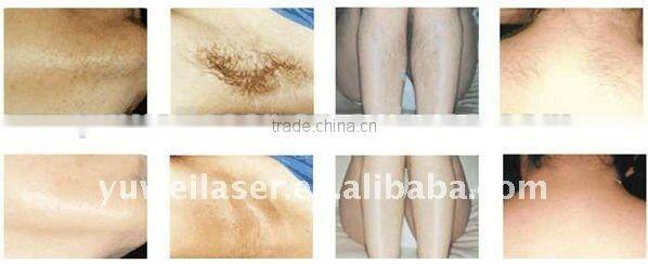 2016 best laser hair removed machine 808 system from Beijing