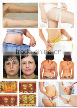 RF Vacuum Roller Warm Massage Skin Tightening With Lipocavitation For Body Shaping