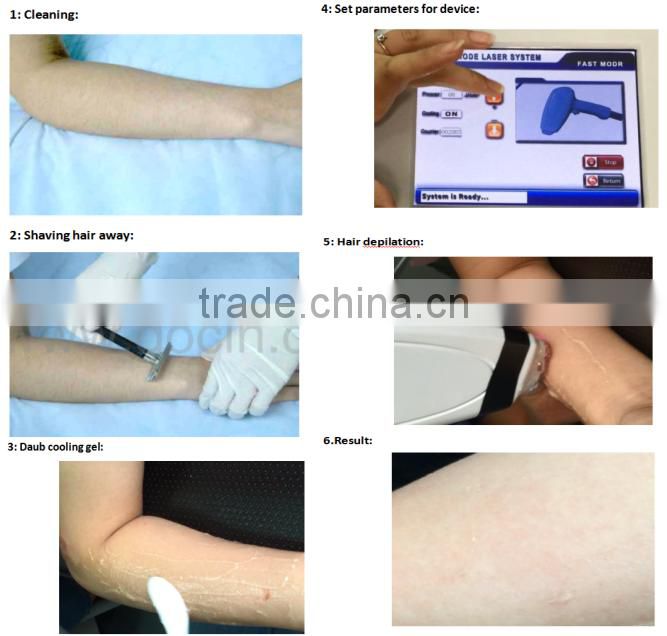 portable 810nm diode laser hair removal / depilation diode laser hair removal / laser diode 810nm portable