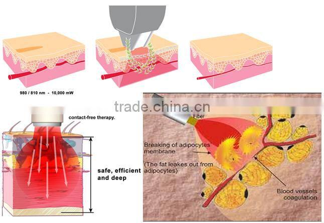 professional diode laser blood vessels removal spider vein / vascular removal equipment