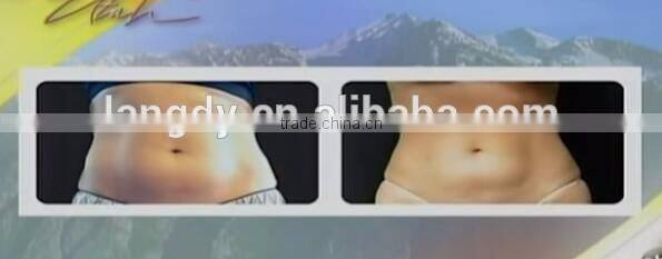 2016 LANGDI good price liposonix hifu slimming equipment / hifu liposonix
