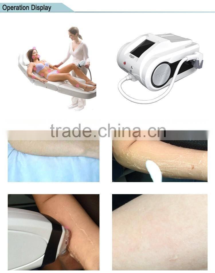 Medical best diode laser 810 nm portable for hair removal diodo laser