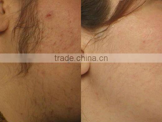 Comfortable cooling probe Beauty equipment FB-P001-Long pluse laser machine for hair removal/spider veins removal
