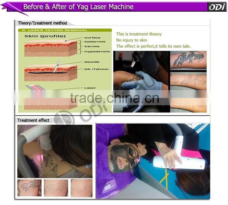 High power black doll laser with factory outlet low laser light price