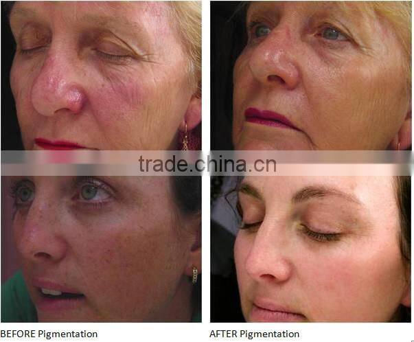 big spot size fast hair removal ipl beauty equipment for sale