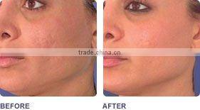 ELIGHT(IPL+RF)hair removal beauty machine