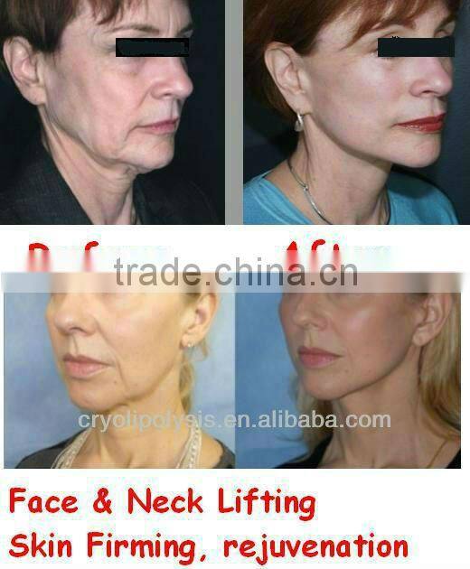 Portable Cyclone RF Slim Vacuum Cryo Liposuction Machine -Cyclone Shape