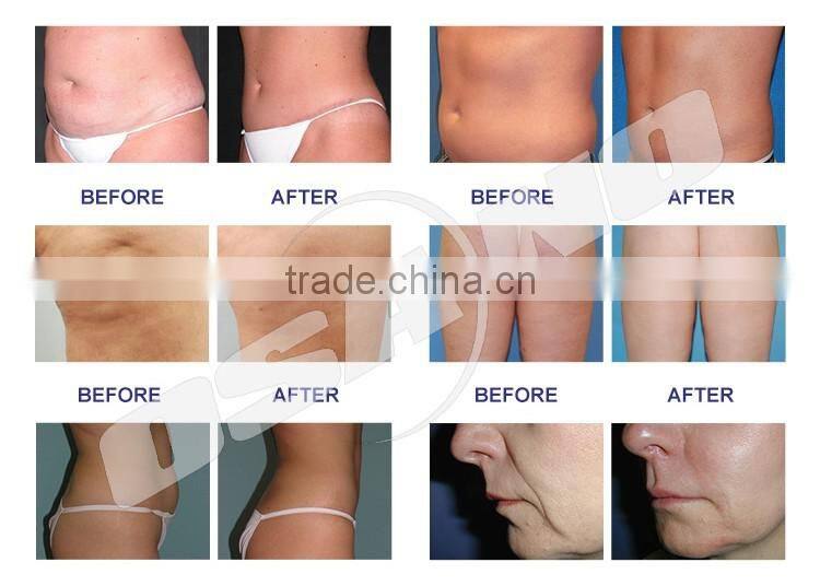 Max Contour 4C cavitation cryolipolysis face slimming rf skin tightening machine