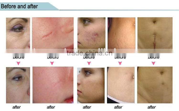 Beauty Device Fractional CO2 Laser for Equipment Vaginal Tightening Machine