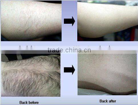 hair removal spray/alexandrite laser hair removal machine