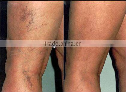 hair loss treatment- medical beauty equipment 1064nm long pulse laser nd yag P003