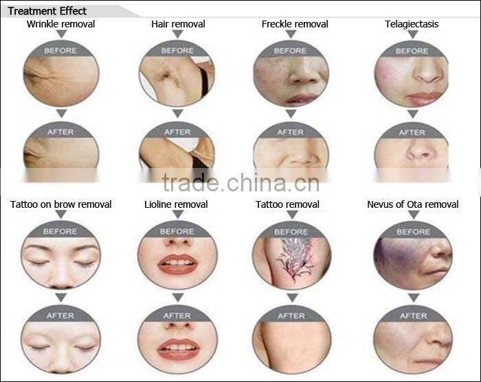 Hot selling CE TUV approved ml 2 in 1 elight+laser yb5