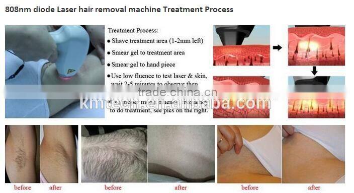 National day promotion High Quality 810nm Diode Laser Medical 808nm diode laser hair removal
