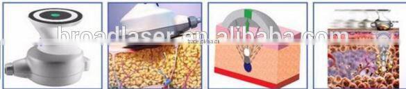 beauty slimming machine ultrashape 2015